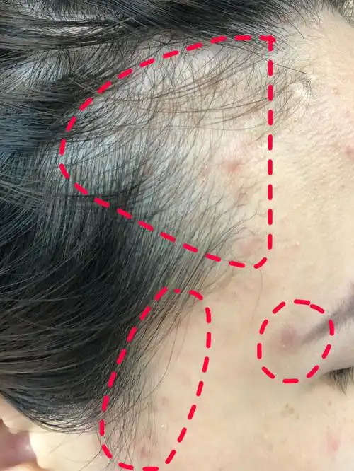 发际线总是长痘痘,会秃头!你知道吗?
