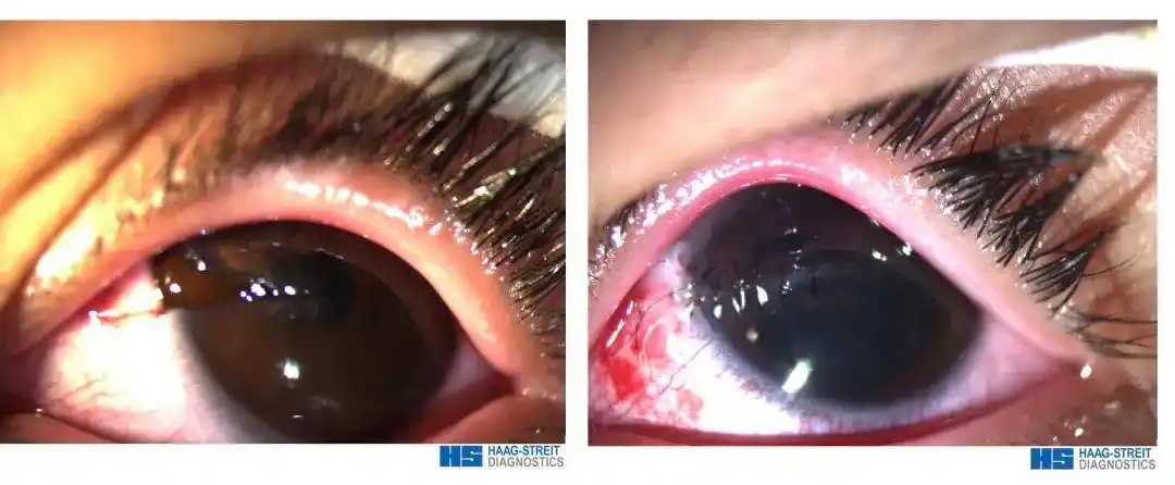 潍坊眼科医院:重视儿童眼外伤,防范于未然