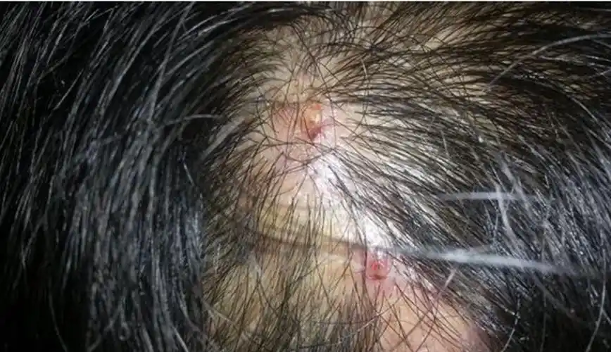 头癣的体现图片