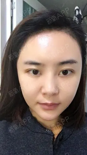 新氧- 氧气6003611473258545 | 自体脂肪填充额头 | 自体脂肪填充