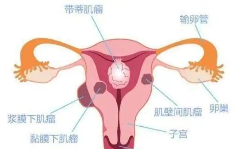 对子宫肌瘤有疑惑? 是否影响生育? 这里帮你解决五大难题!