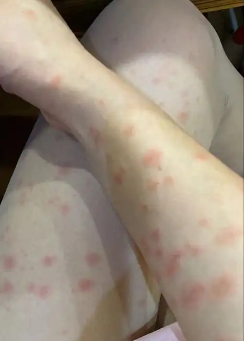 许柳田:玫瑰糠疹是个什么病?中医用什么清除它的法门在哪?