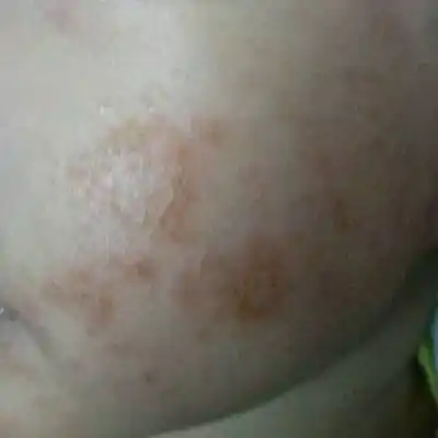 我家宝宝脸上湿疹严重,到医院检查说是蛋白质过敏(医生看一下说是蛋白