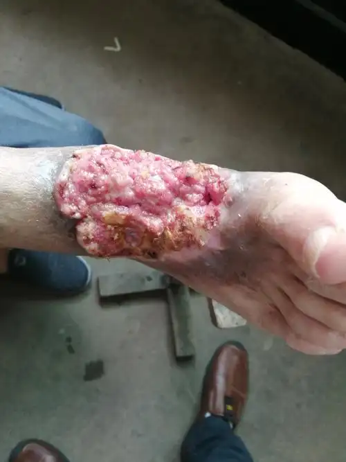 慢性下肢溃疡 - 中医皮肤版 - 爱爱医医学论坛