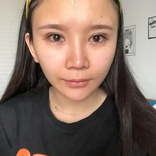 打卡自体脂肪填充手术经验分享