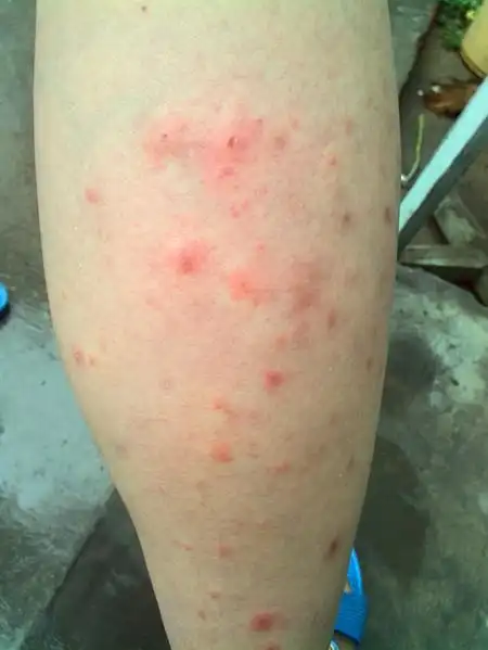 问:腿上这是怎么了?过敏?还是其他的?