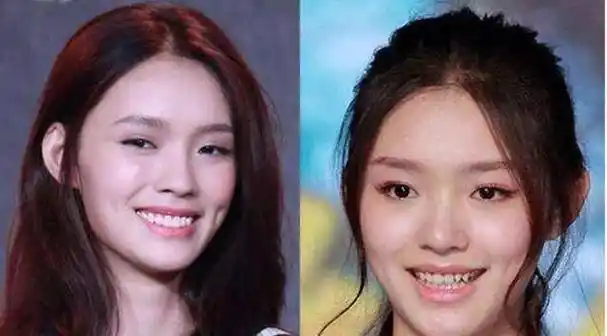 明星新闻盖过国家新闻_明星整牙都拔了牙吗_新闻明星做陶瓷牙