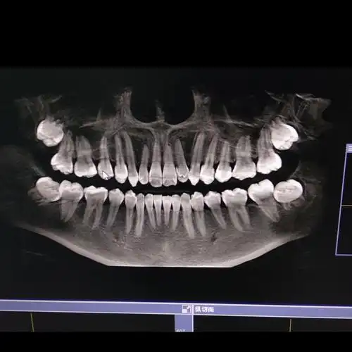 下颚智齿冒尖尖了,拔一颗会很贵吗