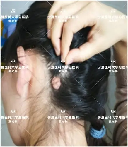 头皮色素痣 - 好大夫在线