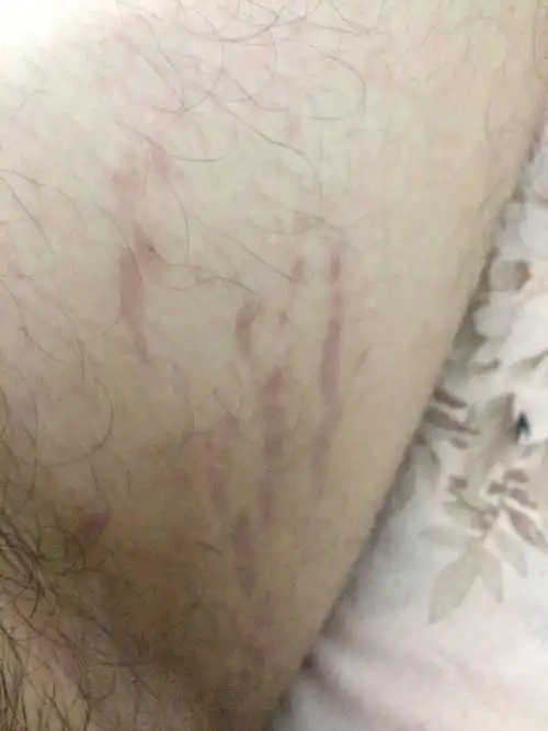 最近一年发现大腿根内侧有红色条状斑纹,左右都有,偶尔本人男,二十五