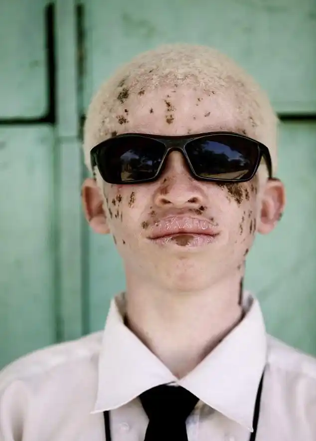 图中的男子是白化病人公益活动家,他也是一名白化病人.