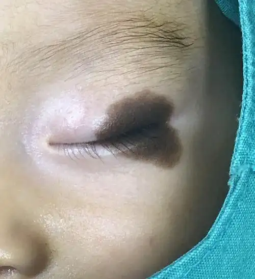 左眼睑分裂痣_眼睑色素痣_眼睑色素痣治疗方式 - 好大夫在线