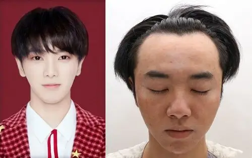 华晨宇植发照疑曝光爆料人称张碧晨插足自己还叫华晨宇老公