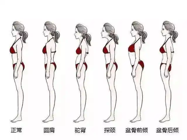 驼背探颈圆肩盆骨前倾不良体态正在偷偷毁掉你的健康
