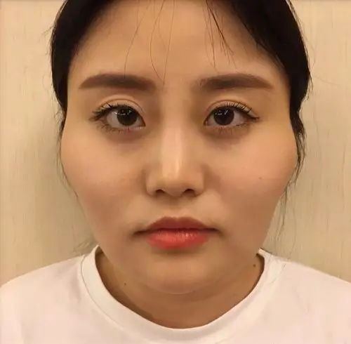 做颧骨内推和下颌角截骨前我的脸超级宽,侧面看起来很_圈子-新氧美容