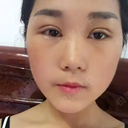 全切双眼皮术后7天_眼综合术后7天_双眼皮术后7天_眼部整形术后7天_ru