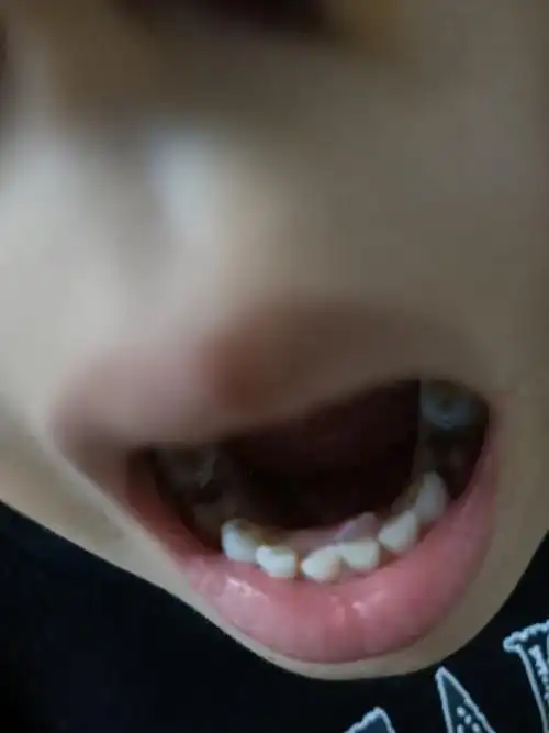 章友求助儿子不到6周岁长了两排牙需不需要拔掉