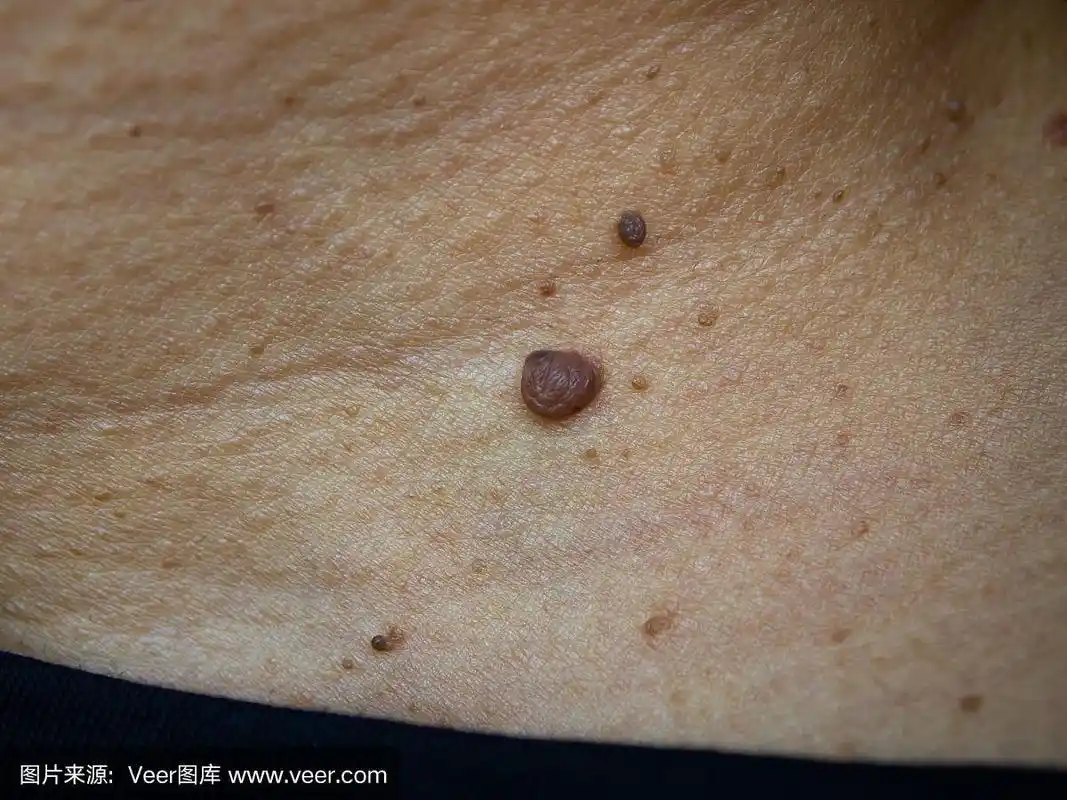 女性颈部棕色痣,医学,近距离微距拍摄,选择性聚焦,亚洲人身体皮肤部分