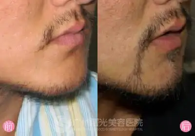 胡须种植,让男人更加有男人味