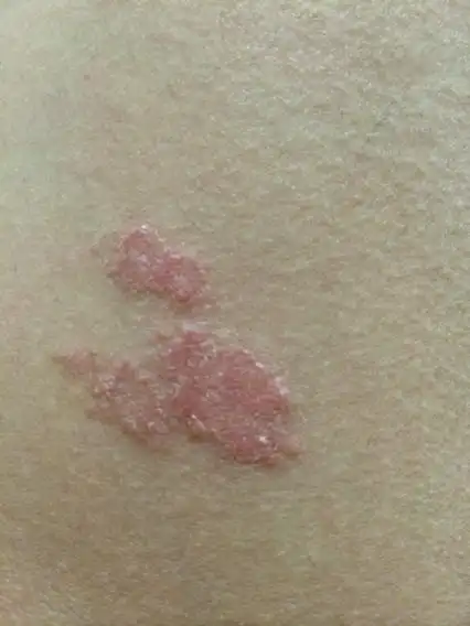 回答 牛皮癣 追问 怎样治疗,是怎么引起的?