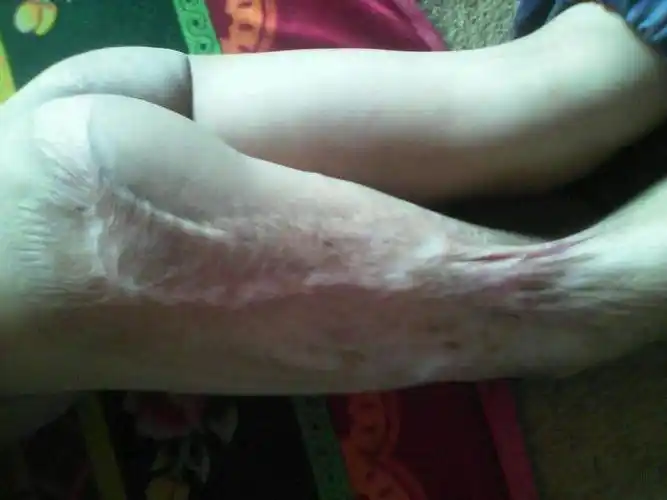 问:三岁多的小孩开水烫伤后留下后遗症可以治疗好吗?