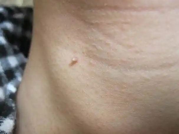 脖子和腋下的"小肉粒"是什么?用手"揪"掉可以吗?涨知识了