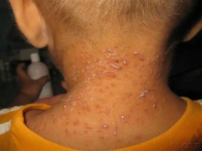 幼儿颈部散发性粟粒大红色丘疹,10余天,有点痒.