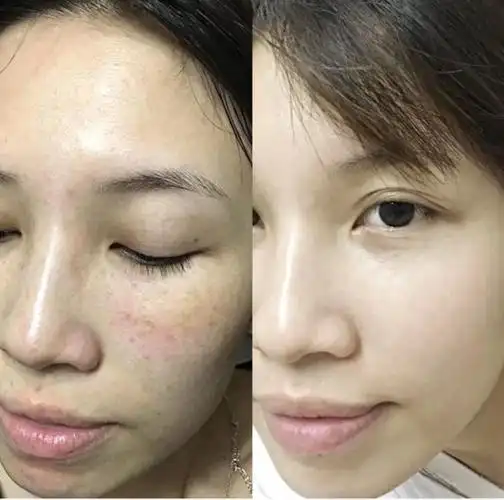 深圳做皮秒或者超皮秒祛斑的医美机构,有推荐吗～?