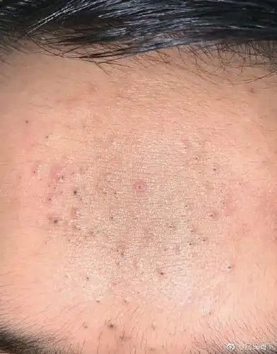 10岁小孩额头长满黑头粉刺如何治疗