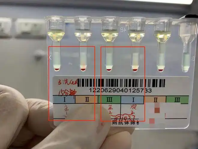 同型输血后患者血型鉴定困难了