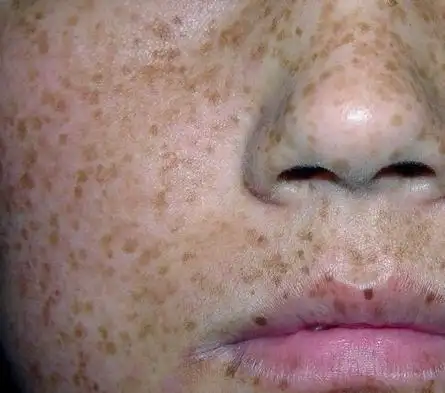 黄褐斑治疗的错误有什么呢_黄褐斑治疗_大成皮肤网