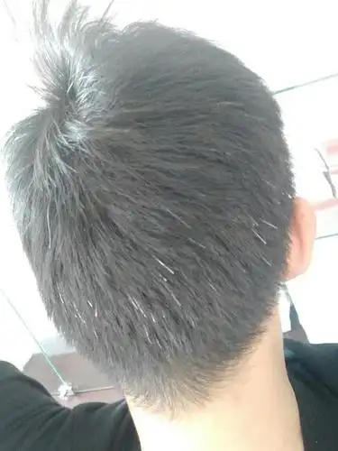 明明很年轻,为什么白头发越长越多?或是缺乏这两种营养