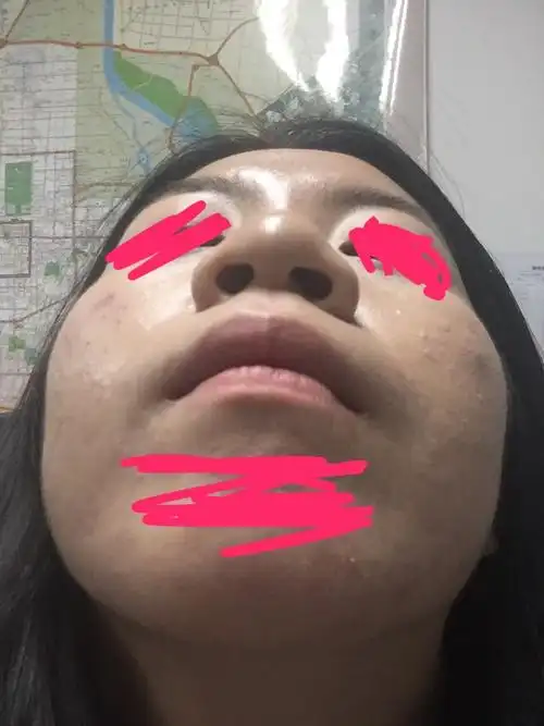 鼻背宽鼻翼肥厚宽鼻头圆钝希望做鼻综合想询问一下方案
