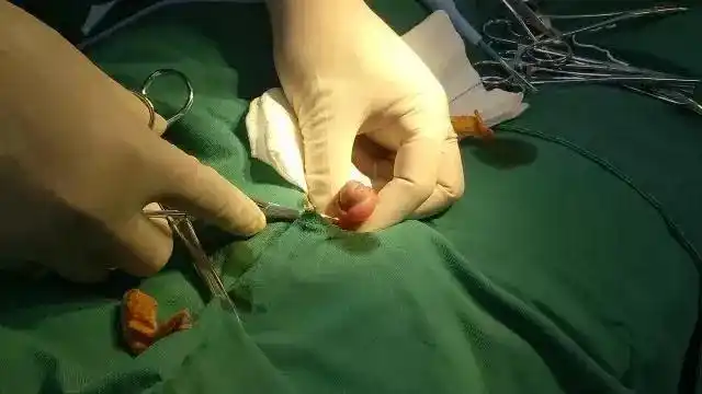 孩子切包皮需要做哪些准备(孩子切包皮需要做哪些准备手术)