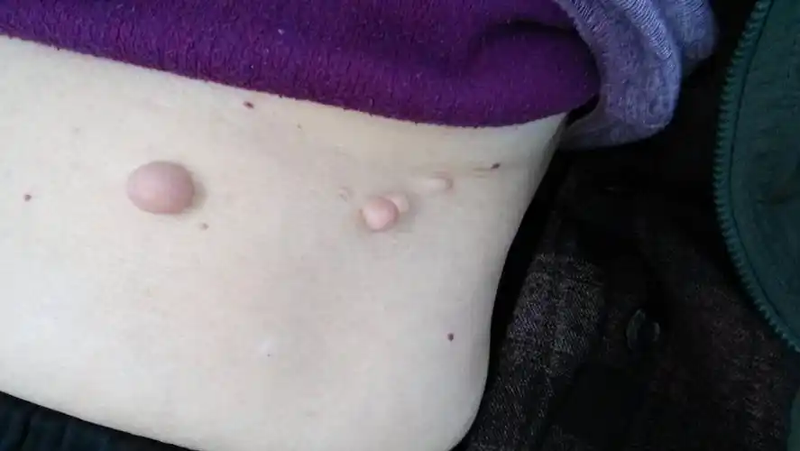 看看这个是什么瘤子