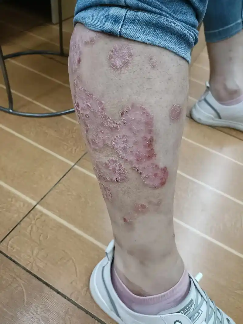 又来一个非常严重的皮肤病,考医生技术的病来了 - 抖音