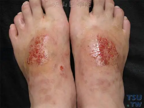 【附图】 湿疹(eczema)的症状表现〔慎入〕_皮肤病诊断图谱 | 天山