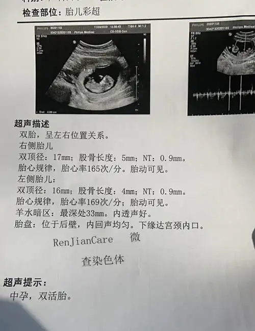 12周加喜得双胞胎女儿真的又怕又惊喜