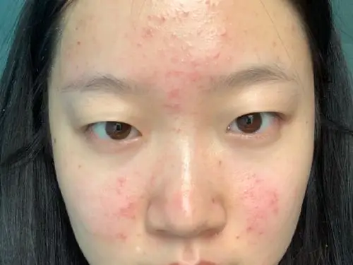 果酸换肤做完爆痘太严重了,第三张是做之前,大概多久能好啊,需要去