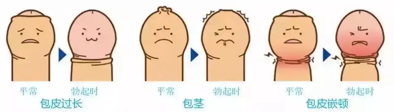 我国男性3岁之前几乎都存在包皮过长或包茎,在对4~18岁男性的调查中