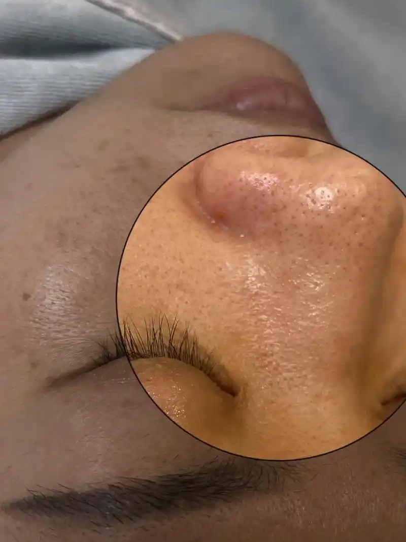 面部肌底深层清洁一次见效深层毛孔清洁是好皮肤的第一步让你不要天天