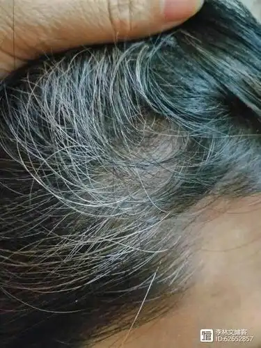 李林文博客长白头发的原因是这些调理白发要对症