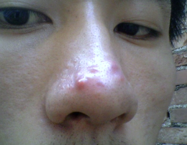 皮囊炎会自己好吗