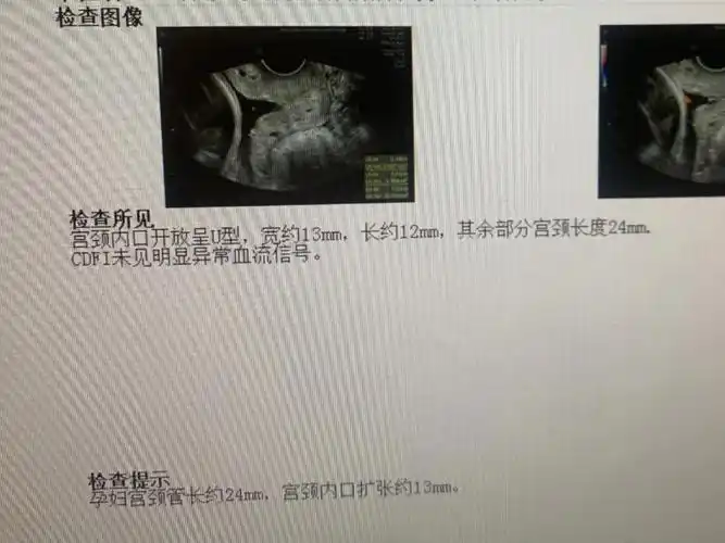 医院查了b超和阴超,宫颈内口扩张10mm,宫颈长度31mm,好在堆堆没事.