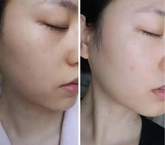 美白针变白过程图(靠美白针变美的女生)(23)