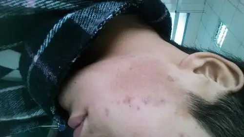 处逐渐变黑,小时候没有,近几年变成这样的,是黑色素沉淀在皮肤里了吗?