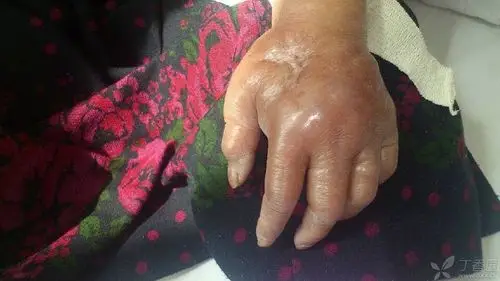 重度水肿患者 [病例帖]