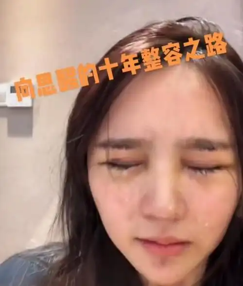 网红项思醒的十年整容之路!曾经是丑小鸭,素颜照辣眼睛