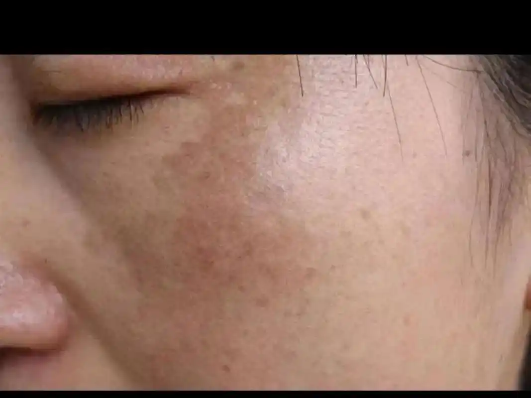 有斑一定要注意防晒,长时间一定要涂防晒霜##玉贵人问题皮肤管 - 抖音