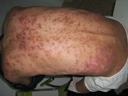 泛发丘疹糜烂渗出伴瘙痒20余天